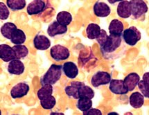 Leczenie Rituksymab+Bendamustyna skuteczne we wznowie po alloprzeszczepieniu komórek...