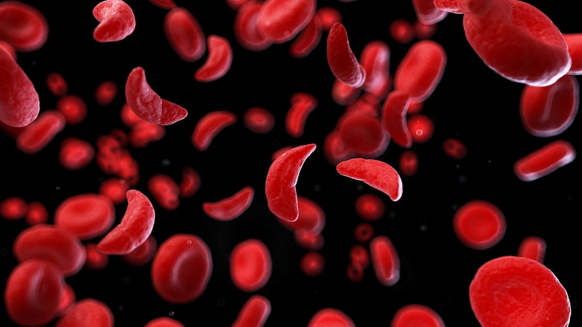 NHS zatwierdza przełomową terapię genową w niedokrwistości sierpowatokrwinkowej