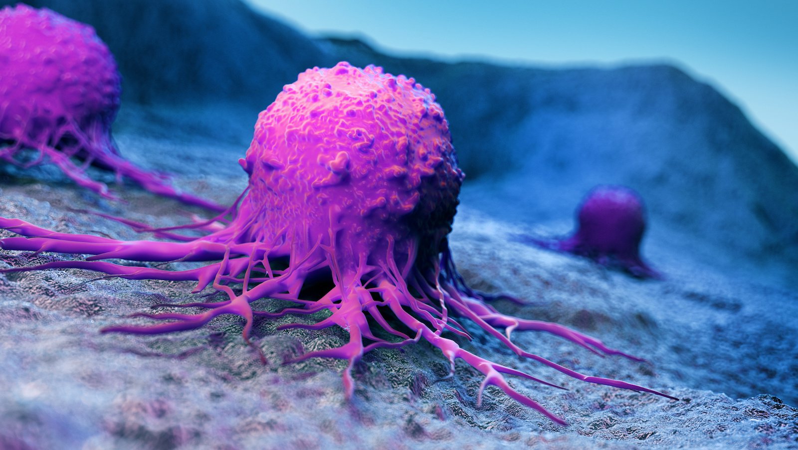 G-CSF i ryzyko nowotworzenia u pacjentów z ciężką przewlekłą neutropenią