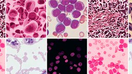 Nowotwory hematologiczne wysokiego ryzyka, 10-11 kwietnia 2015, Wrocław