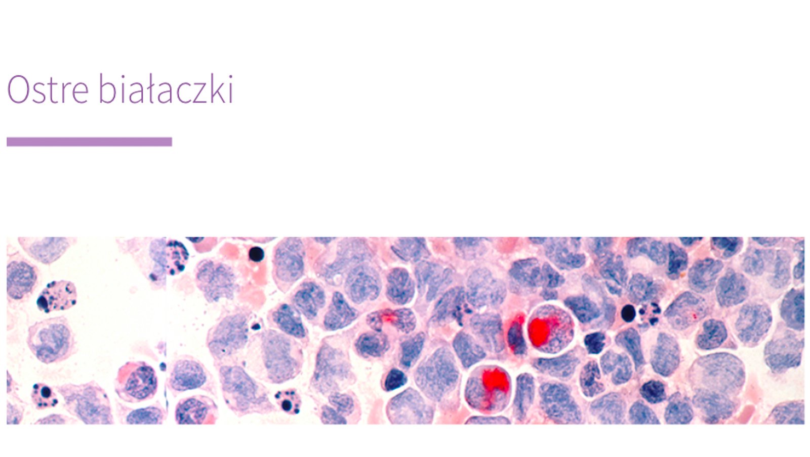 Aktualizacja zakładki o ostrych białaczkach dostępna