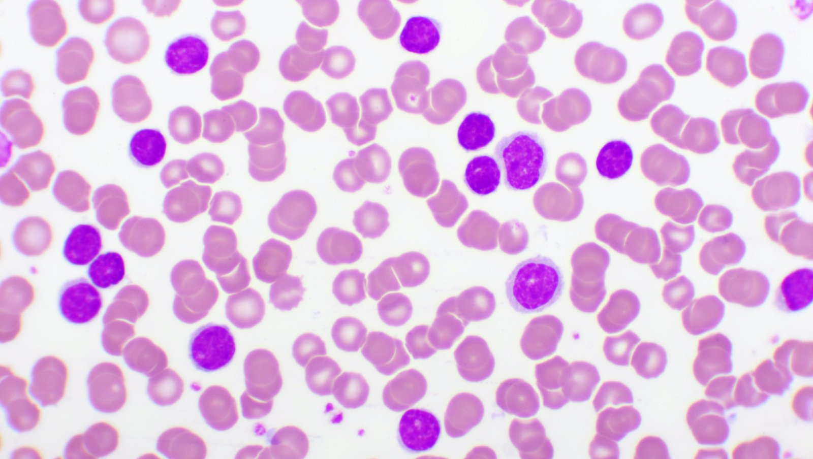 Pacjenci z przewlekłą białaczką limfocytową (PBL) nadal czekają na dostęp do leczenia