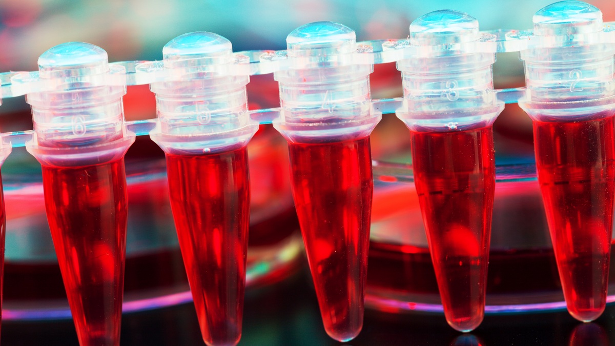 PTCy versus ATG jako profilaktyka choroby przeszczep-przeciwko-gospodarzowi w zgodnych niespokrewnionych przeszczepieniach komórek krwiotwórczych