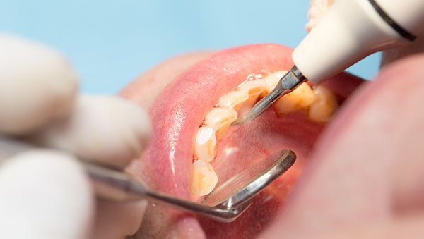 Postępowanie w profilaktyce i leczeniu powikłań w jamie ustnej po leczeniu onkologicznym