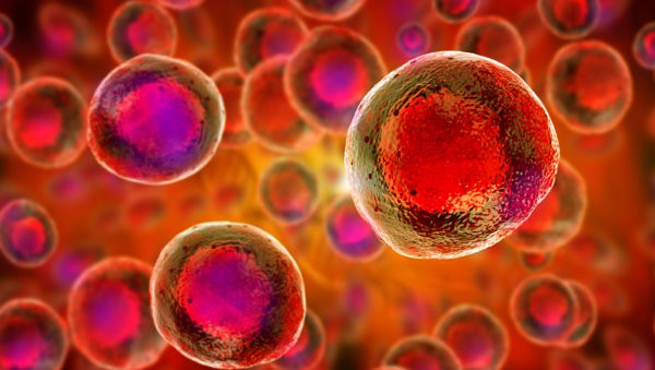 Przeszczepienie alogenicznych komórek krwiotwórczych u pacjentów z zespołem mielodysplastycznym z delecją 5q