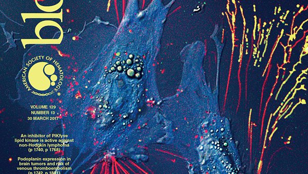 Przeszczepienie alogenicznych komórek krwiotwórczych w MDS i CMML: rekomendacje międzynarodowego panelu ekspertów