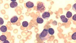 Przeżycie chorych na PBL po przerwaniu ibrutynibu