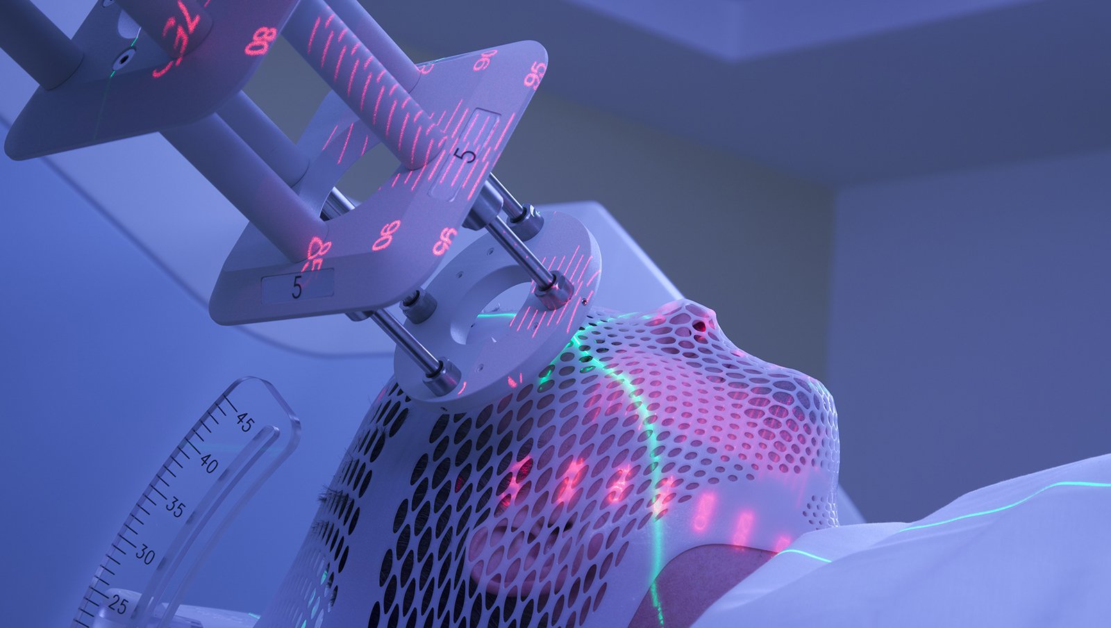 Porównanie radioterapii w dawce 4 Gy i 24 Gy w leczeniu chłoniaka grudkowego i chłoniaka strefy brzeżnej – 5-letnia aktualizacja wieloośrodkowego, randomizowanego badania III fazy FoRT