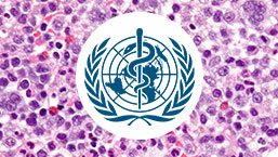 Reklasyfikacja zespołów mielodysplastycznych wg WHO. Co nowego i dlaczego?