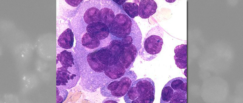 Rola obrazowania techniką rezonansu magnetycznego w szpiczaku plazmocytowym – zalecania...