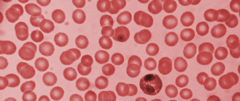 Romiplostym u chorych na zespoły mielodysplastyczne niższego ryzyka wg IPSS z małopłytkowością