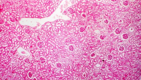 Rozwijające się koncepcje dotyczące nerkowej mikroangiopatii zakrzepowej związanej z HSCT oraz perspektywy nowych terapii