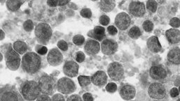 Ryzyko drugich nowotworów u chorych na HL