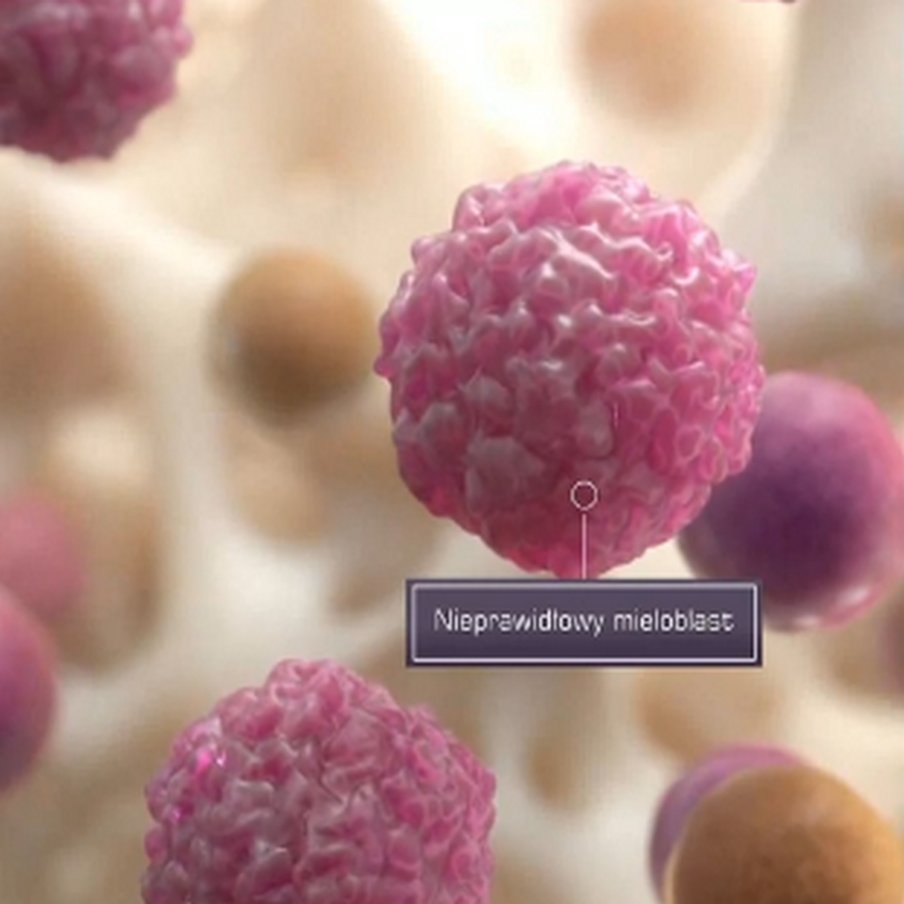 Wenetoklaks w terapii ostrej białaczki szpikowej