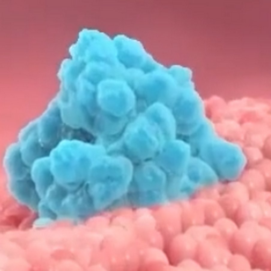 Wenetoklaks w terapii przewlekłej białaczki limfocytowej