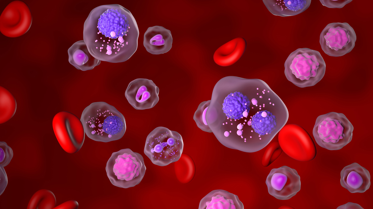 Objawy szpiczaka plazmocytowego często są mylone z innymi dolegliwościami wieku starszego. Perspektywy pacjentów chorujących na ten nowotwór coraz lepsze
