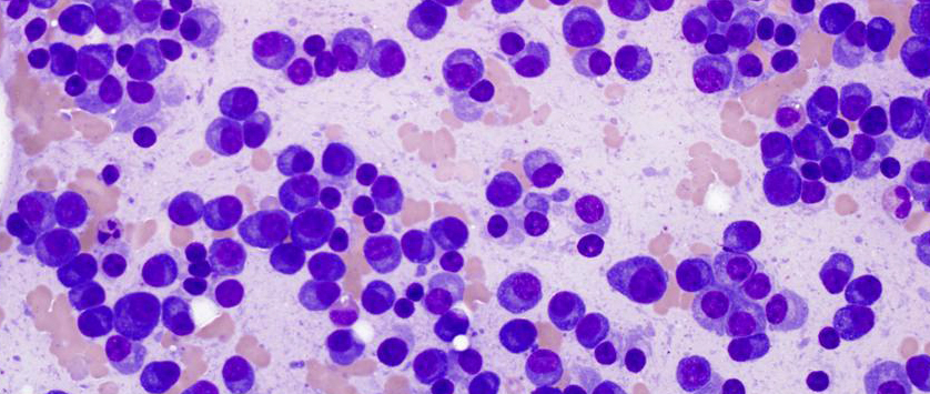 Mobilizacja komórek krwiotwórczych u pacjentów z szpiczakiem plazmocytowym po przebytej...