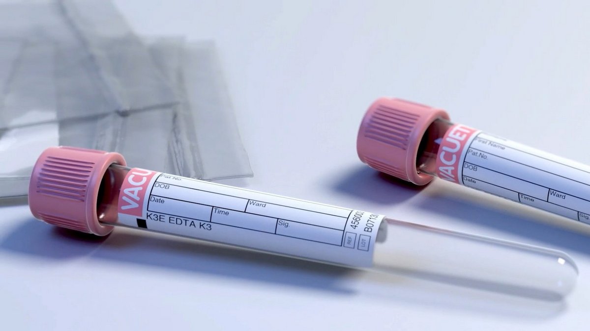 Test suchej kropli krwi: mały krok dla lekarza, duży krok w stronę postawienia diagnozy