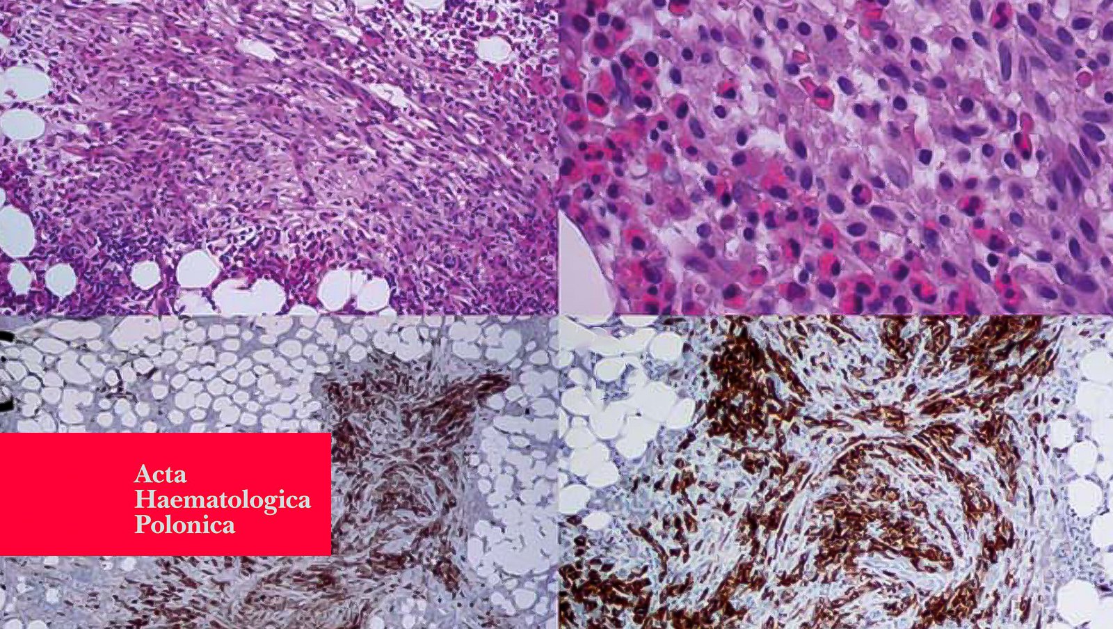 Zastosowanie midostauryny w leczeniu agresywnej mastocytozy układowej – opis przypadku