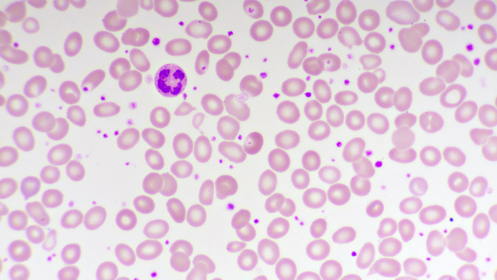 Nadpłytkowość u dzieci i młodzieży — klasyfikacja, podejście diagnostyczne i postępowanie terapeutyczne