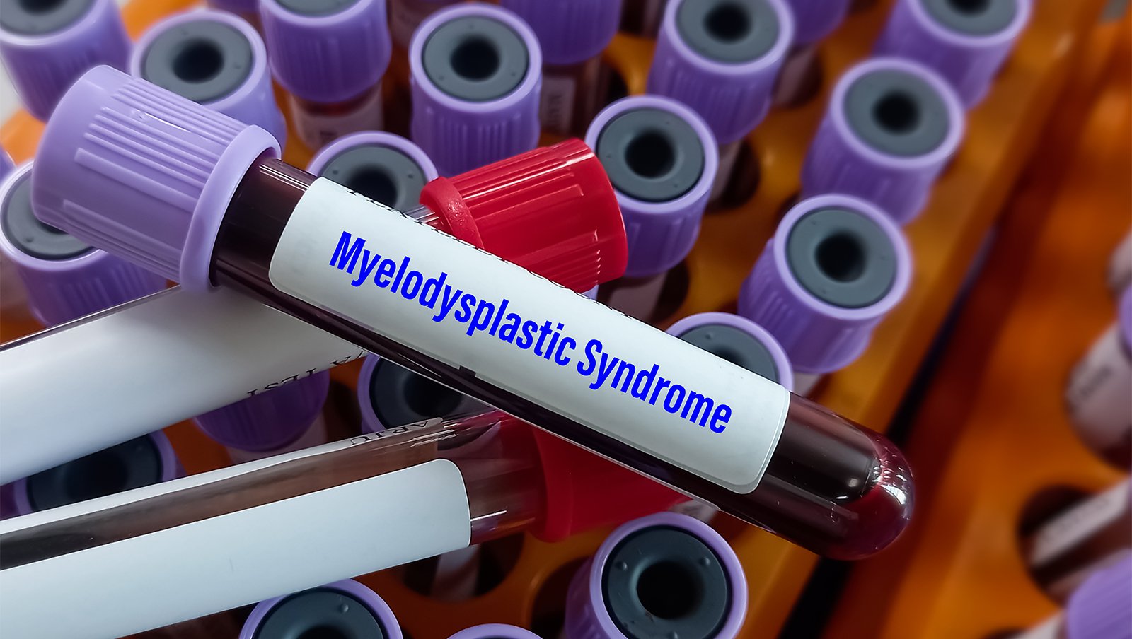 Enasidenib daje trwałą odpowiedź w MDS z mutacją IDH2