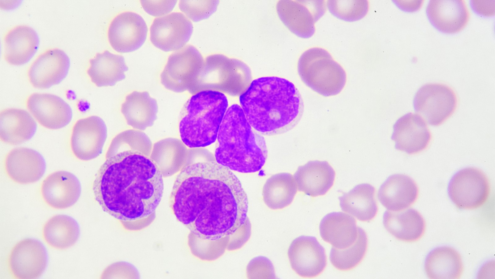 "Intensywna dynamiczna terapia oparta na doświadczeniu" w hematoonkologii - czyli...