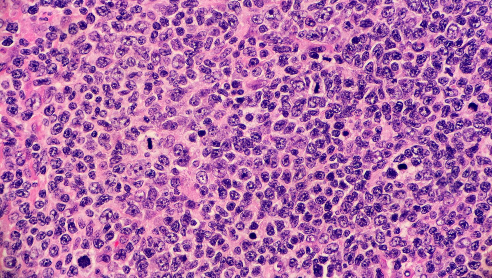 Interim PET w chłoniaku grudkowym jako narzędzie w strategii leczenia dostosowanego do odpowiedzi