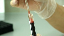 Wlew ciągły niskich dawek czynnika VIII u pacjentów z hemofilią A