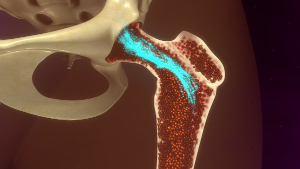 Wpływ typu zajęcia pozaszpikowego w rozpoznaniu szpiczaka na przebieg choroby