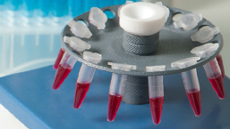 Wyniki przeszczepienia allogenicznych krwiotwórczych komórek macierzystych w samoistnym zwłóknieniu szpiku kostnego