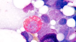 Występowanie somatycznych mutacji komórek krwiotwórczych w różnych grupach wiekowych populacji ogólnej