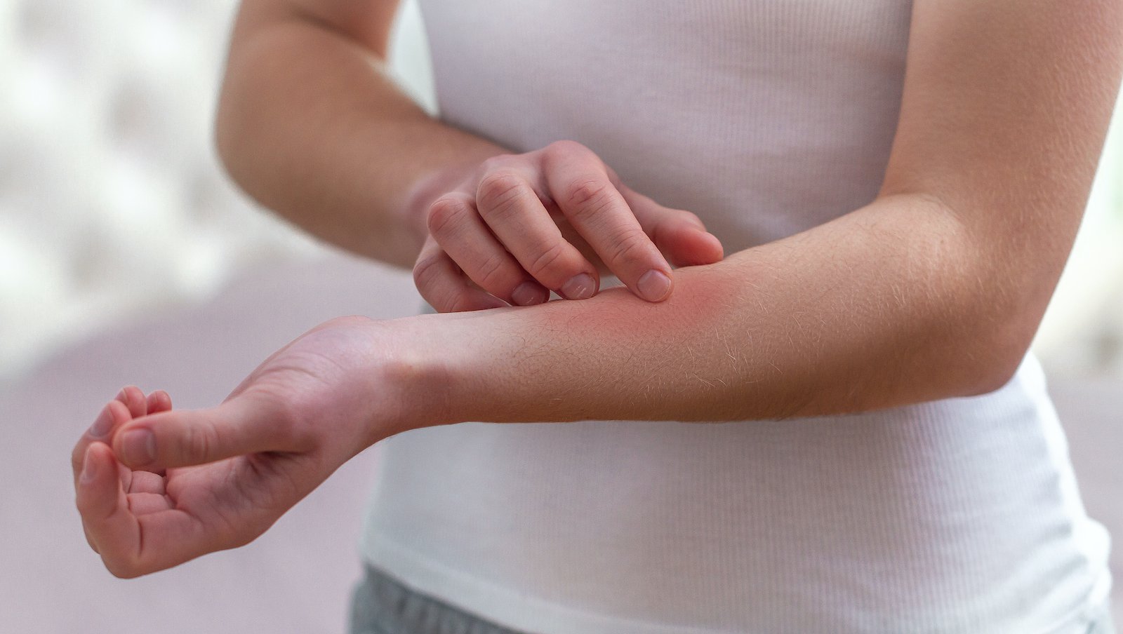 Chłoniaki pierwotne skóry z komórek T | Poradnik dla lekarzy