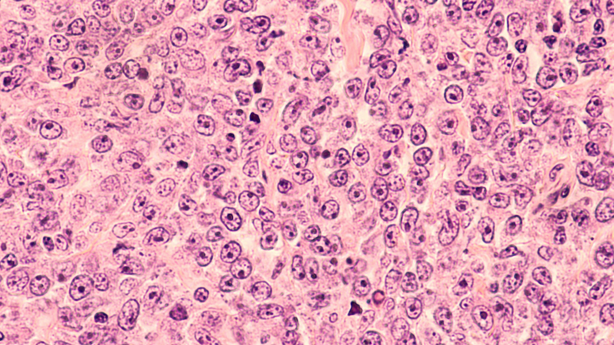 Chłoniaki - aktualizacja zakładki