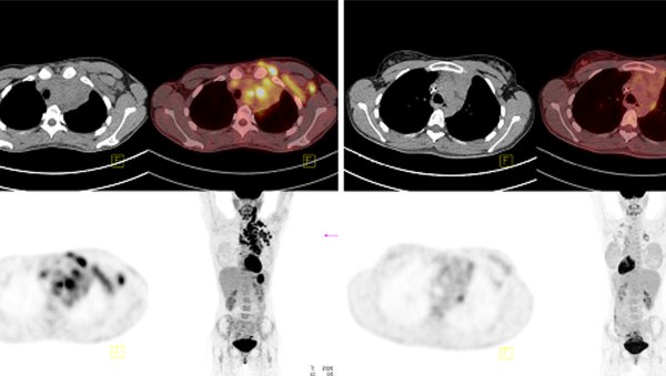 Zastosowanie brentuksymabu vedotinu w leczeniu opornej klasycznej postaci chłoniaka Hodgkina